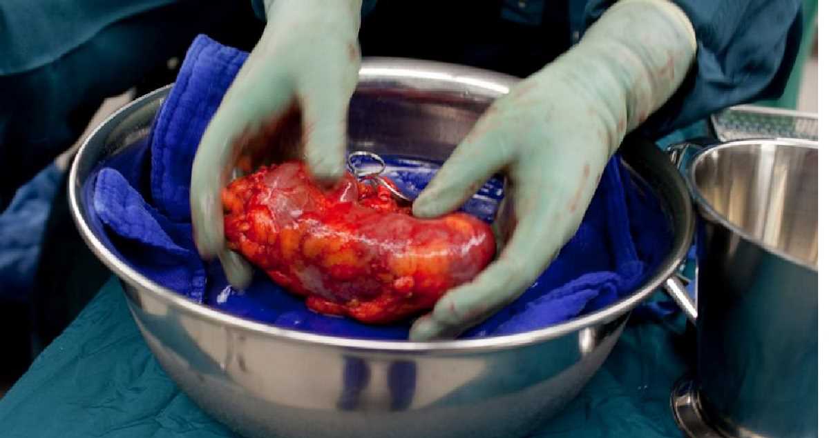 अंग दान के लिए मौत की परिभाषा: ब्रेन डेड या दिल बंद होना?